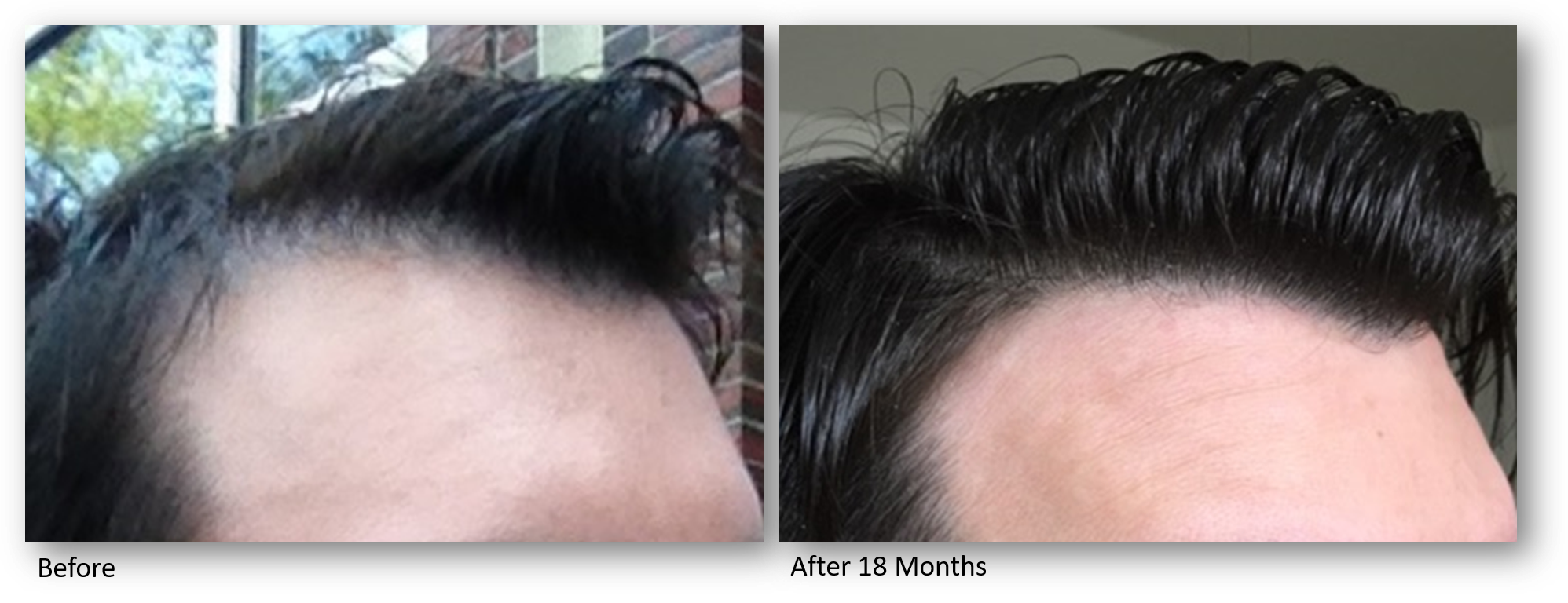 What is KERALASE and Why is It Better than PRP? Best Hair Loss